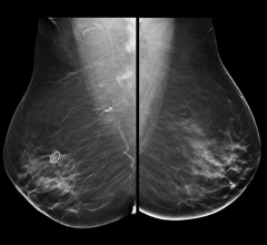 The latest MyBreastAI Suite supports clinicians in accelerating breast cancer detection, while the company’s Pristina Bright solution helps healthcare providers start a new contrast program